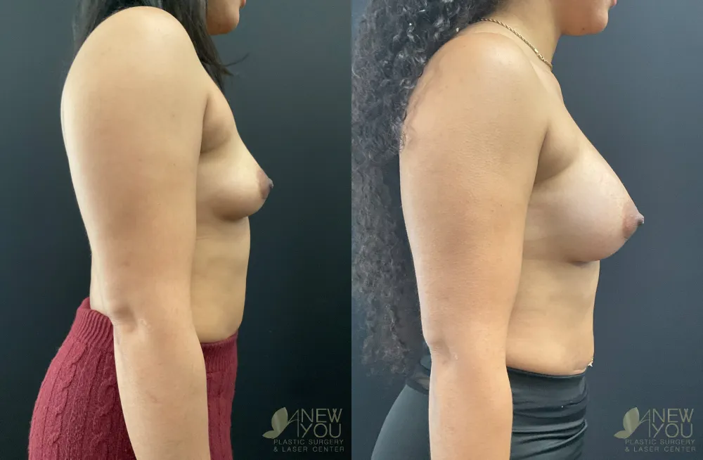 breast-augmentation-108a-ba3