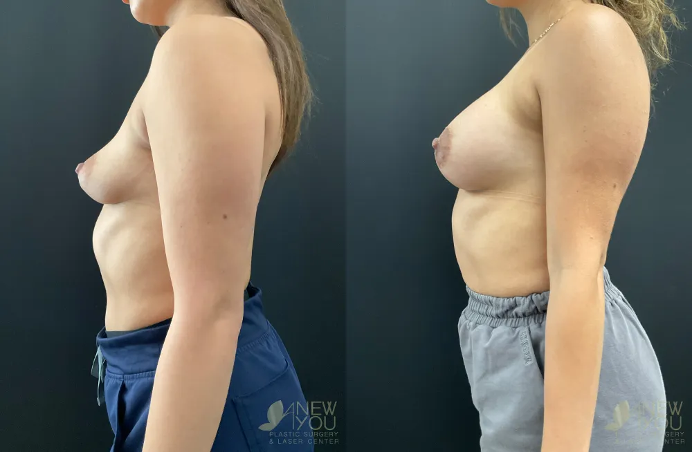 breast-augmentation-109a-ba3