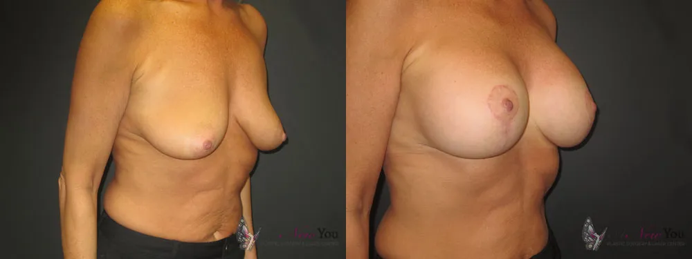breast-augmentation-10a-ba1
