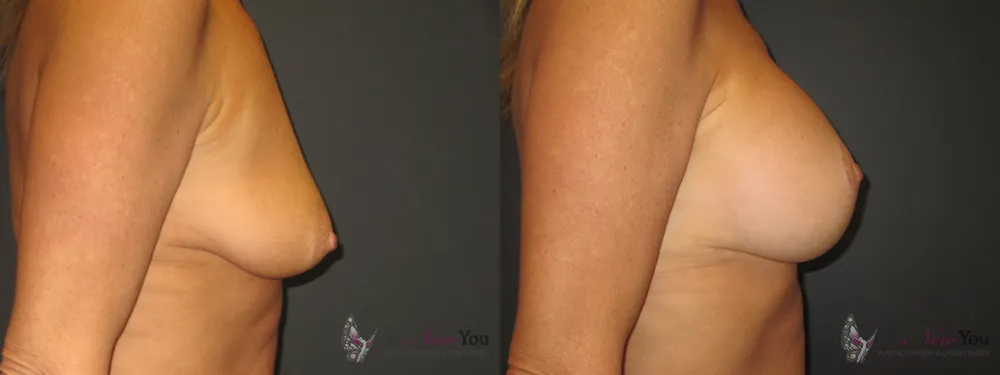 breast-augmentation-10a-ba2