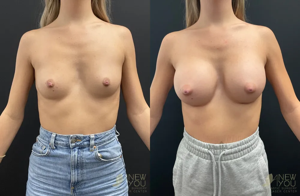 breast-augmentation-110a-ba1