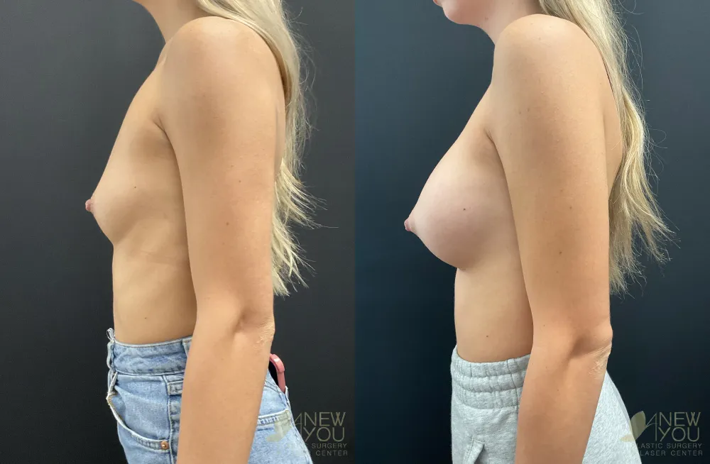 breast-augmentation-110a-ba3