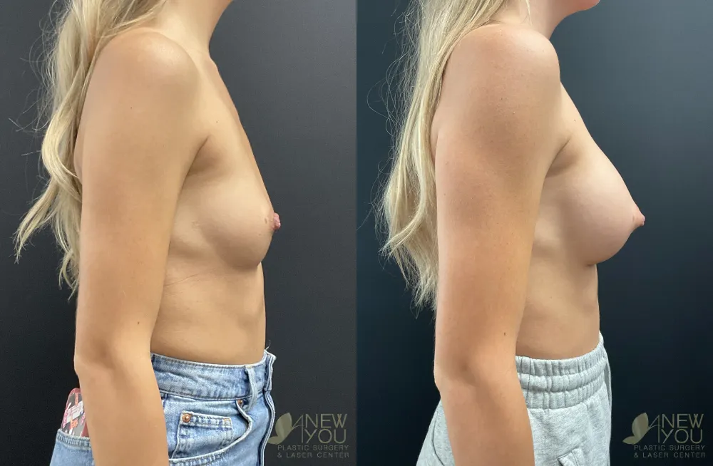 breast-augmentation-110a-ba5