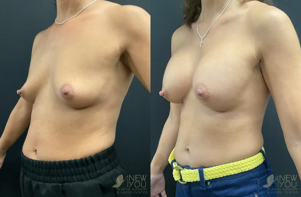 breast-augmentation-111a-ba2