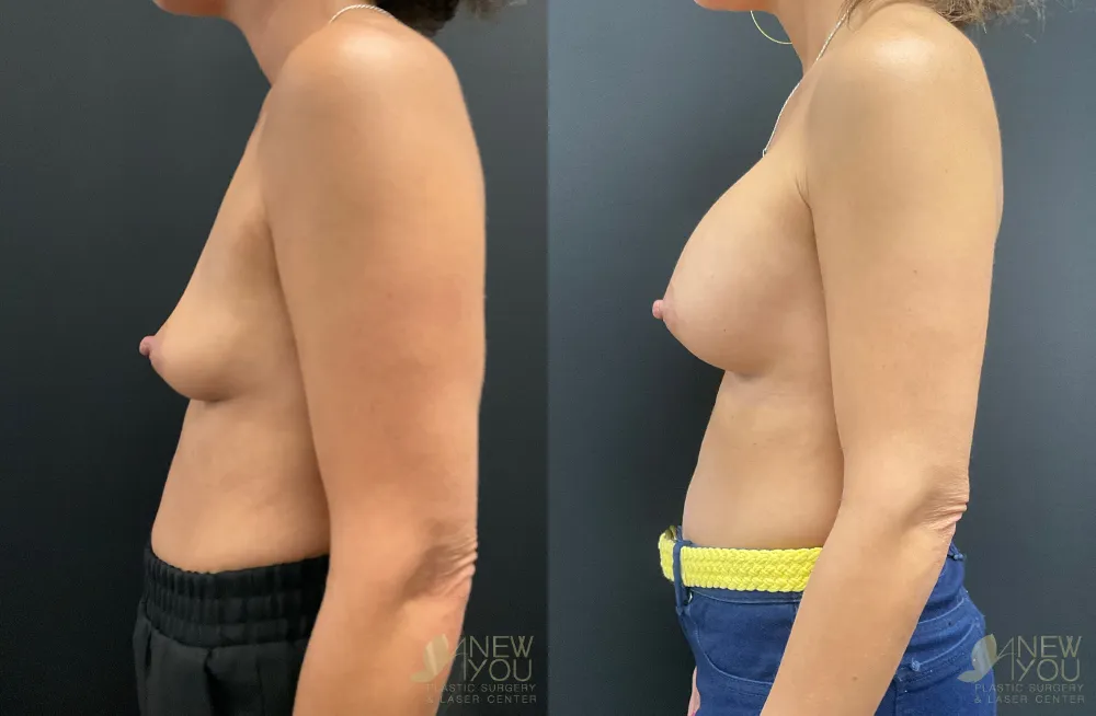 breast-augmentation-111a-ba3