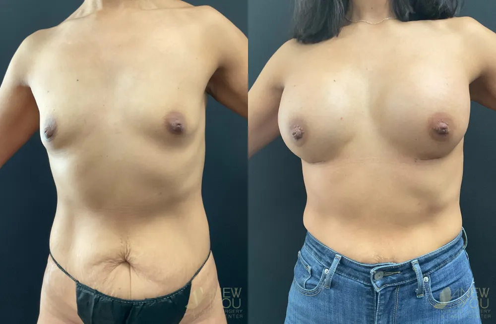breast-augmentation-113a-ba1