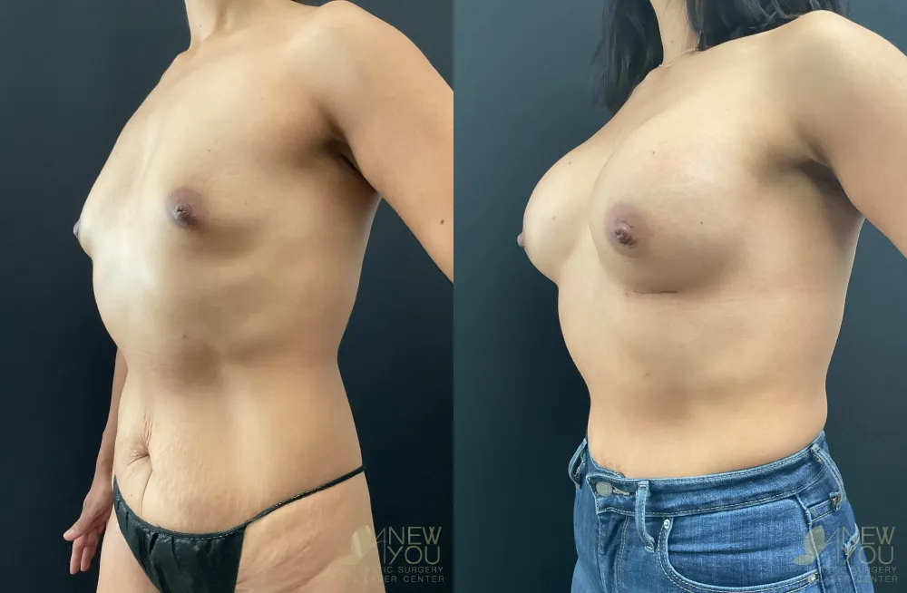 breast-augmentation-113a-ba2