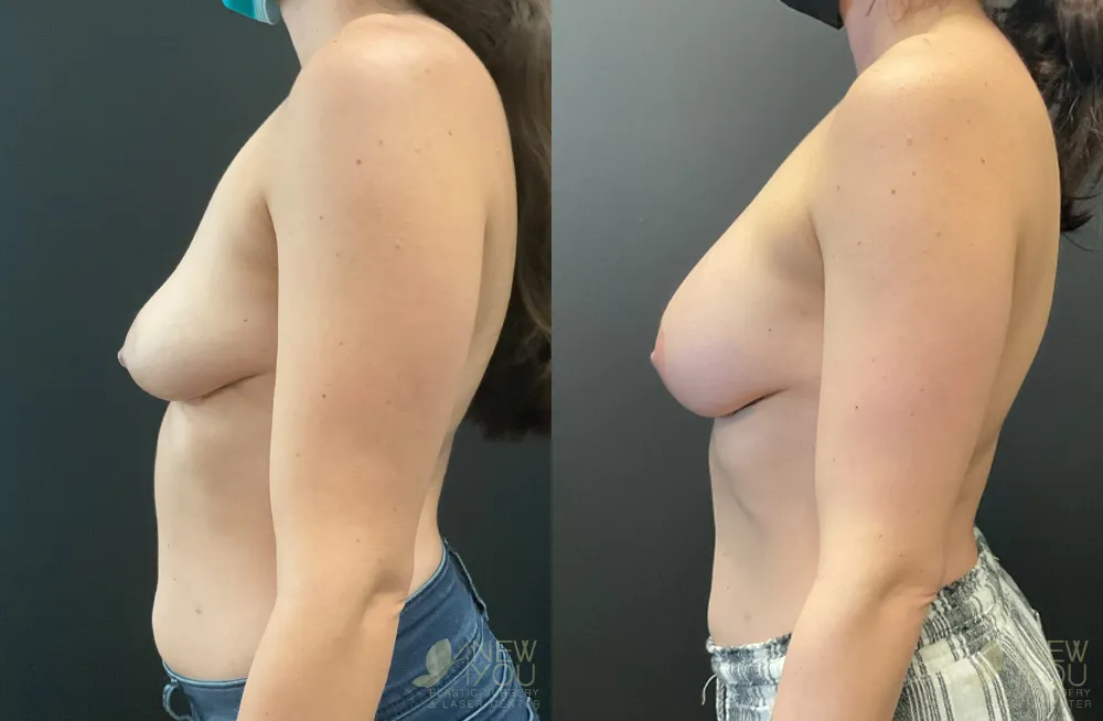 breast-augmentation-113a-ba2