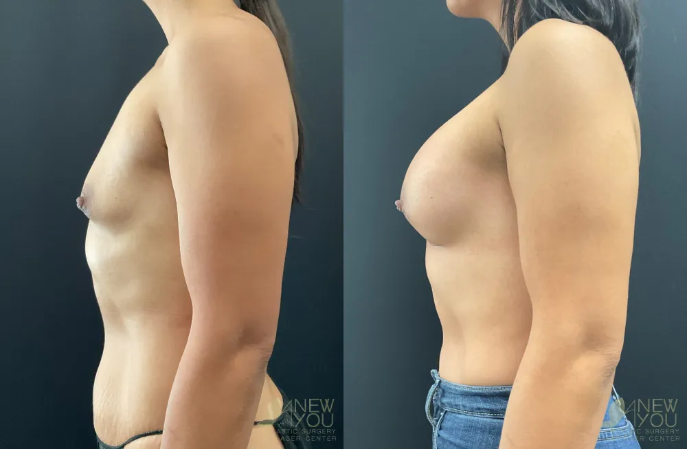 breast-augmentation-113a-ba3