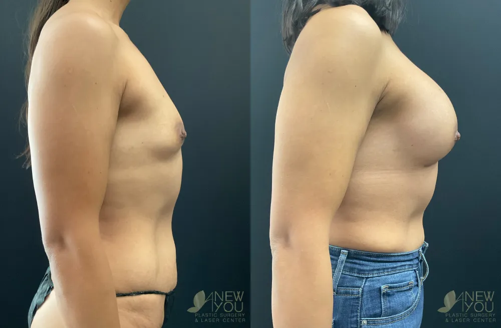 breast-augmentation-113a-ba4