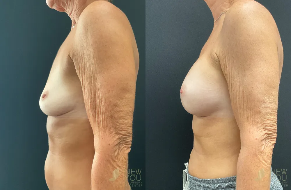 breast-augmentation-115a-ba3