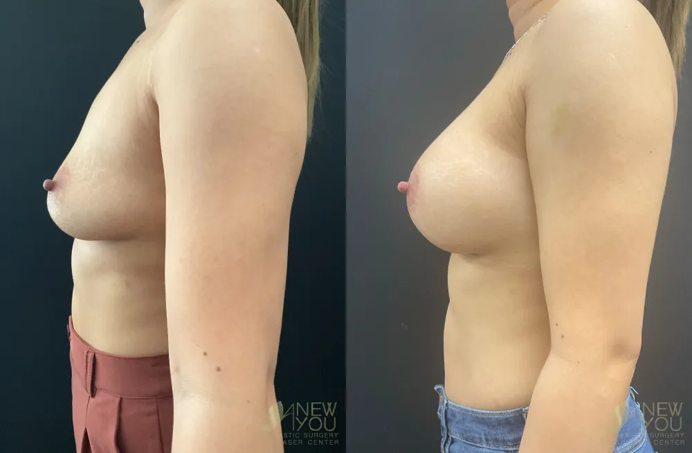 breast-augmentation-116a-ba3