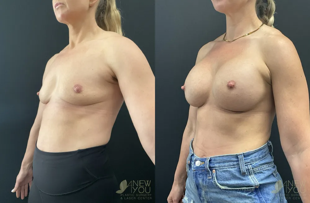 breast-augmentation-117a-ba2