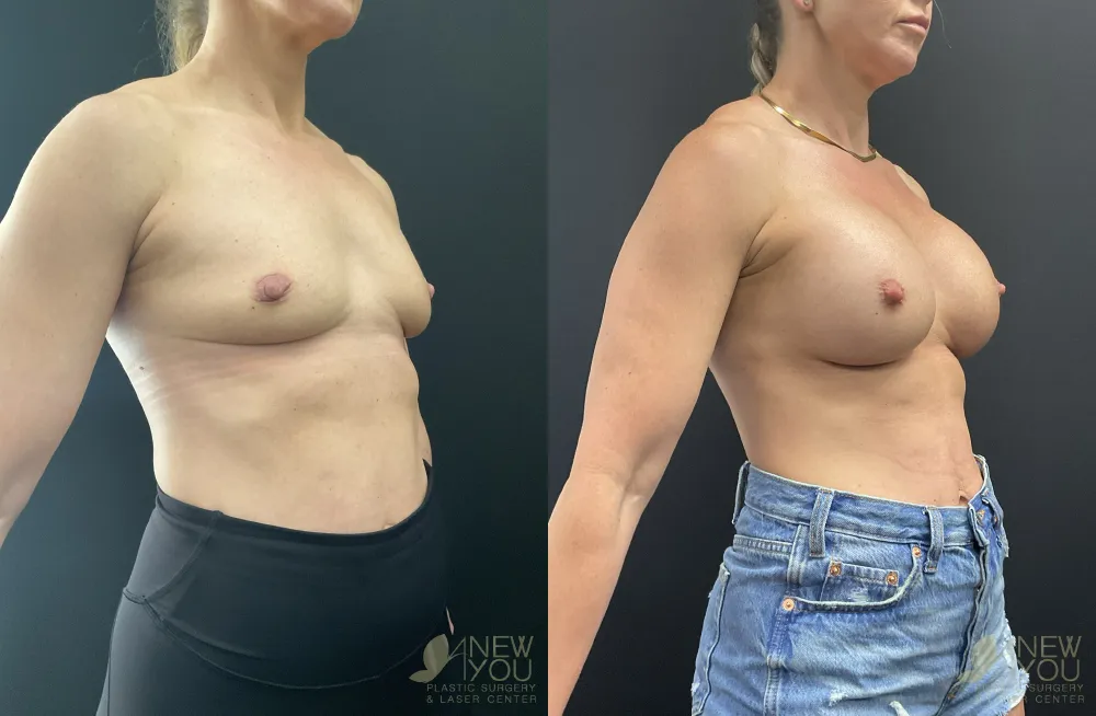 breast-augmentation-117a-ba3