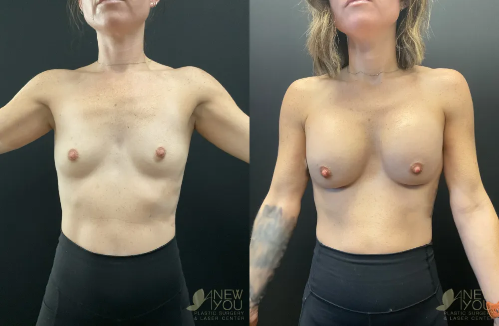 breast-augmentation-118a-ba1