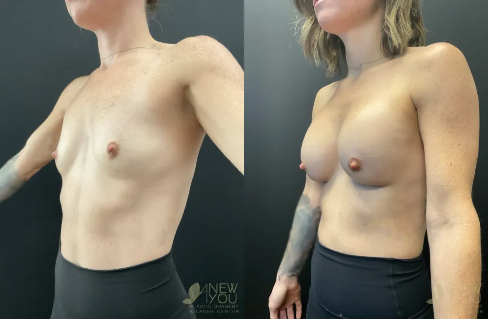 breast-augmentation-118a-ba2