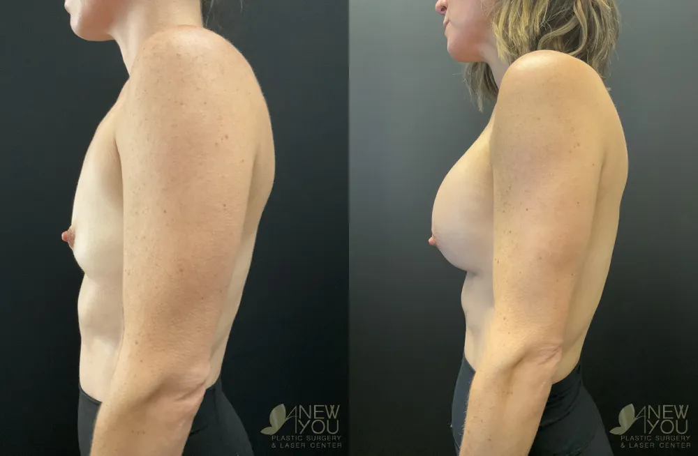 breast-augmentation-118a-ba3