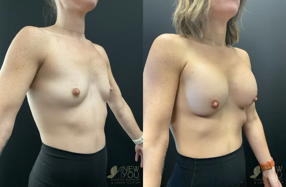 breast-augmentation-118a-ba4