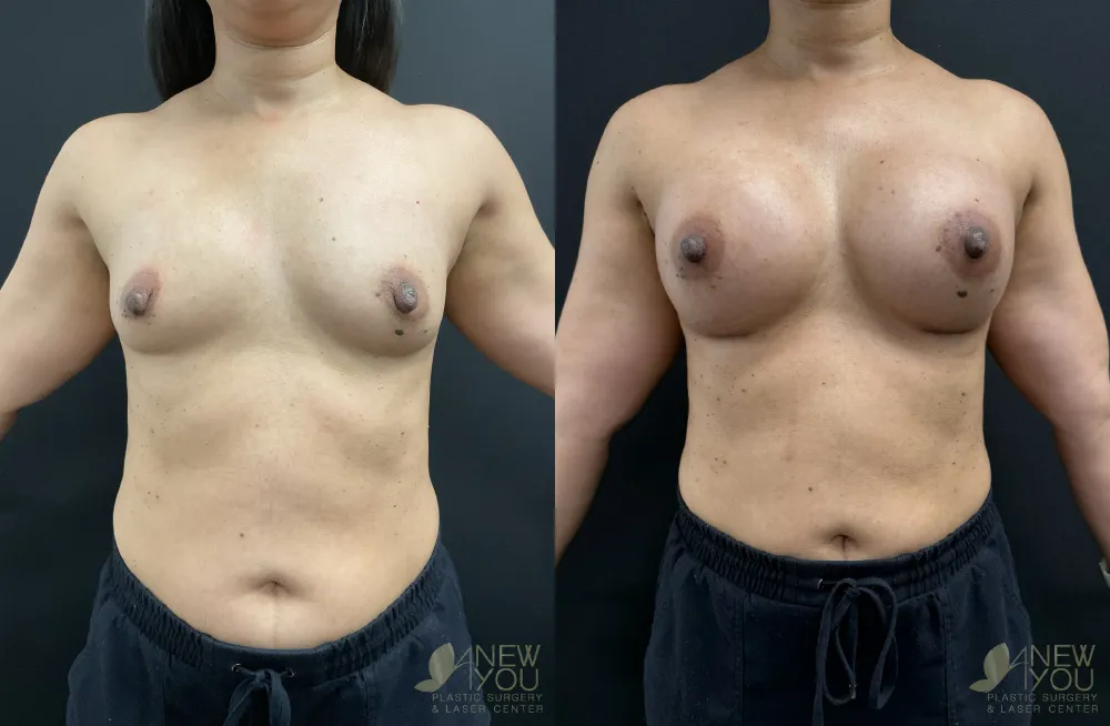 breast-augmentation-119a-ba1