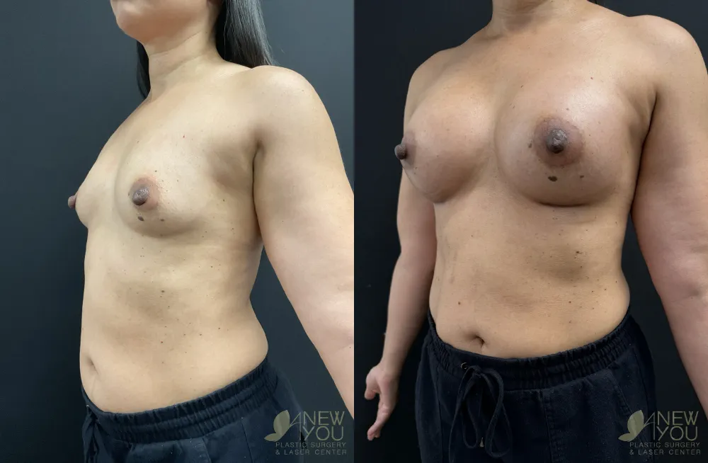 breast-augmentation-119a-ba2