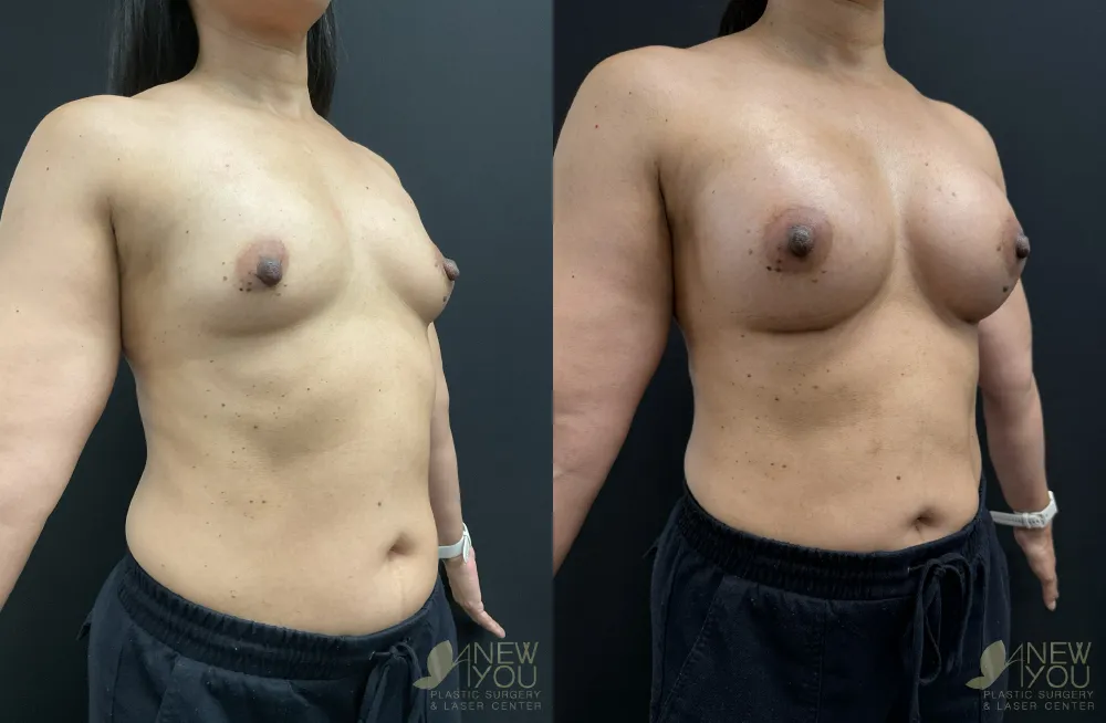 breast-augmentation-119a-ba3