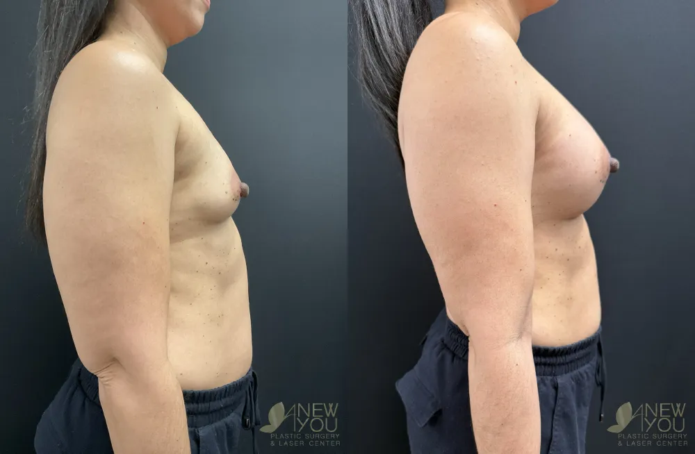 breast-augmentation-119a-ba4