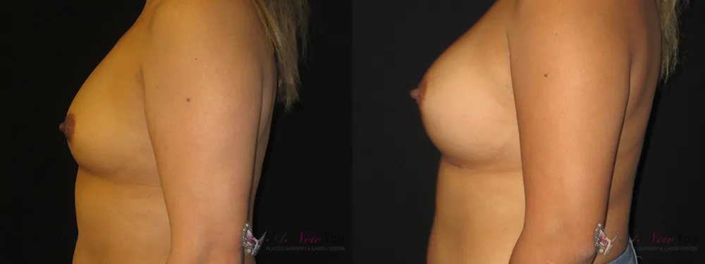 breast-augmentation-11a-ba3