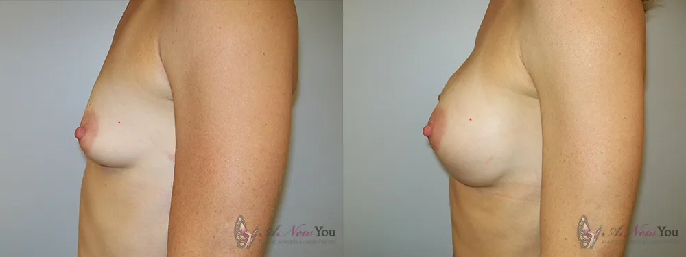breast-augmentation-12a-ba2