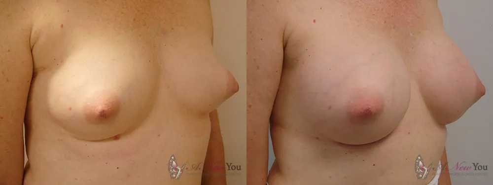 breast-augmentation-13a-ba2