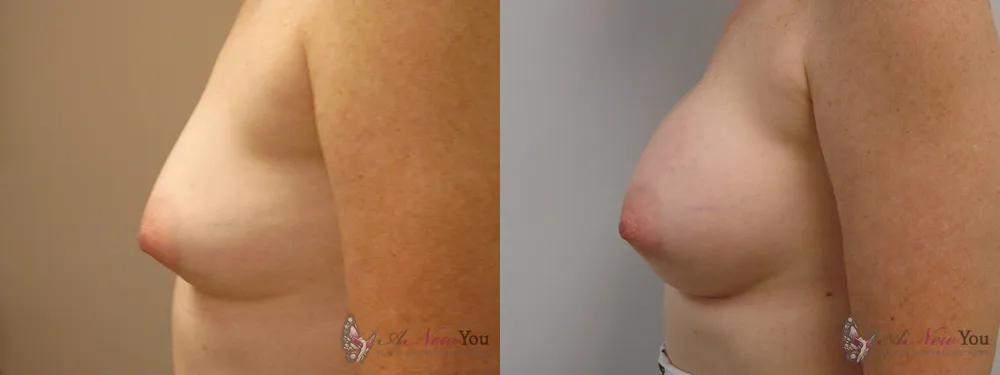 breast-augmentation-13a-ba3