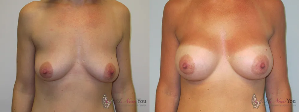 breast-augmentation-17a-ba1