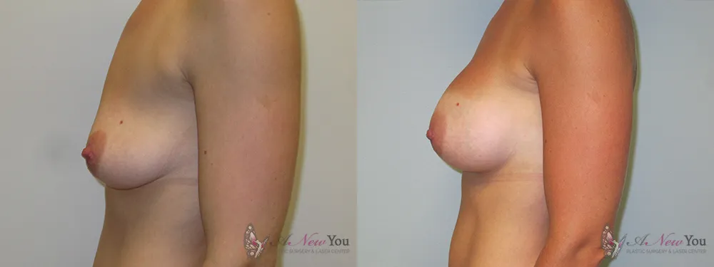 breast-augmentation-17a-ba2