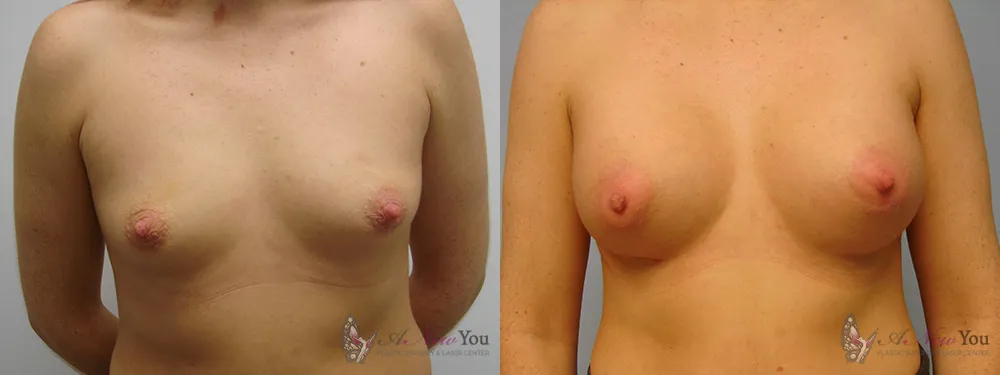 breast-augmentation-18a-ba1