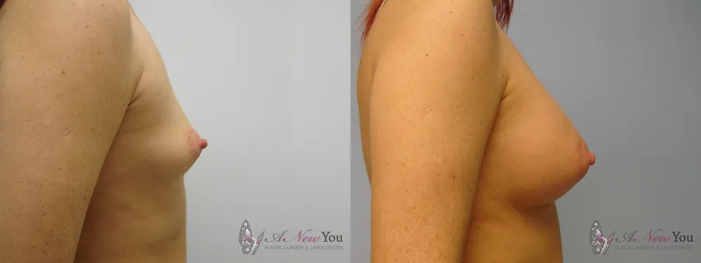 breast-augmentation-18a-ba2