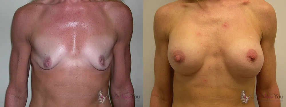 breast-augmentation-19a-ba1