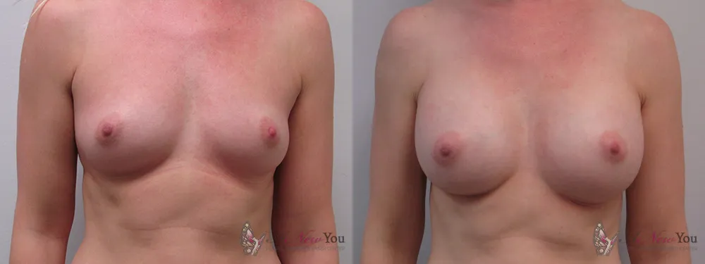 breast-augmentation-20a-ba1