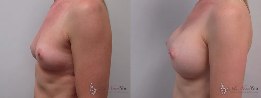 breast-augmentation-20a-ba3