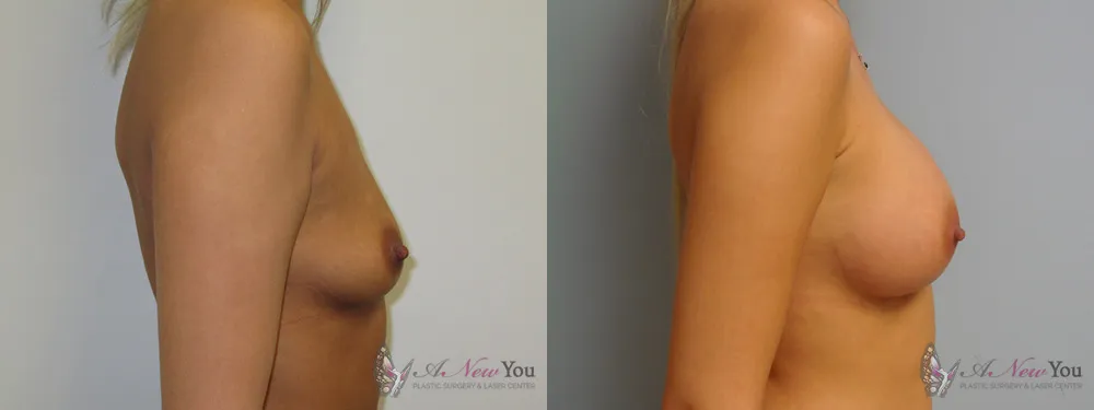 breast-augmentation-21a-ba2