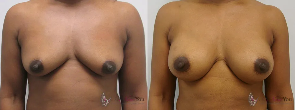 breast-augmentation-22a-ba1