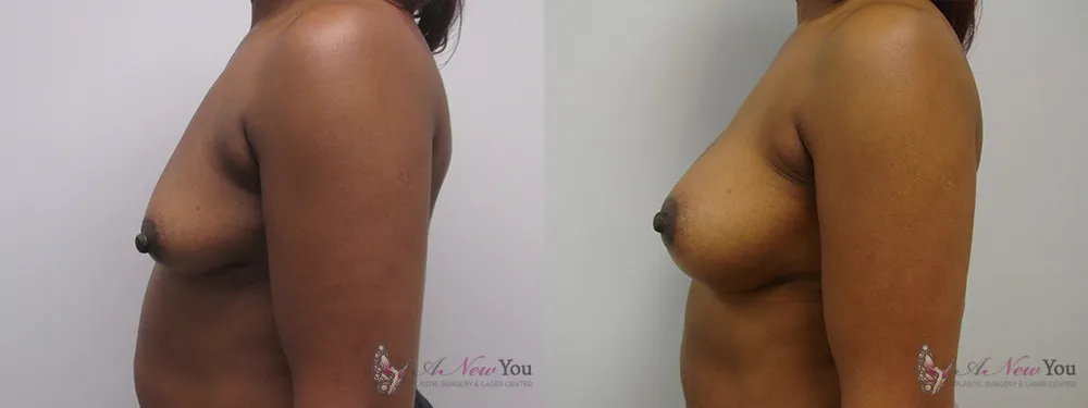 breast-augmentation-22a-ba3