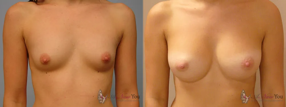 breast-augmentation-24a-ba1