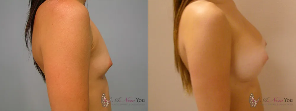 breast-augmentation-24a-ba2
