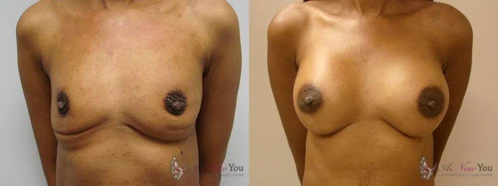 breast-augmentation-25a-ba1