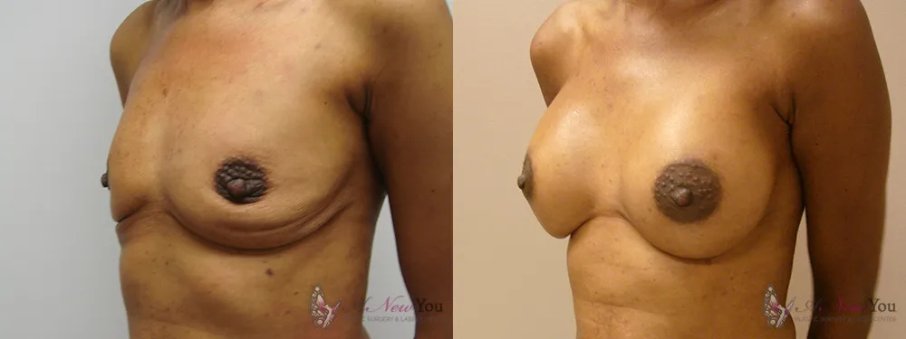 breast-augmentation-25a-ba2