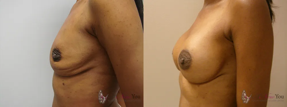 breast-augmentation-25a-ba3