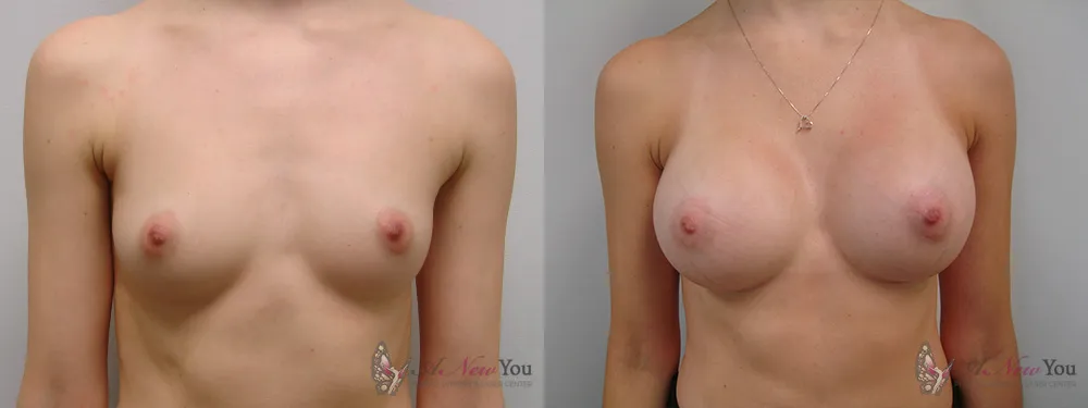 breast-augmentation-27a-ba1