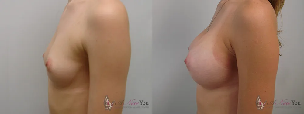 breast-augmentation-27a-ba3