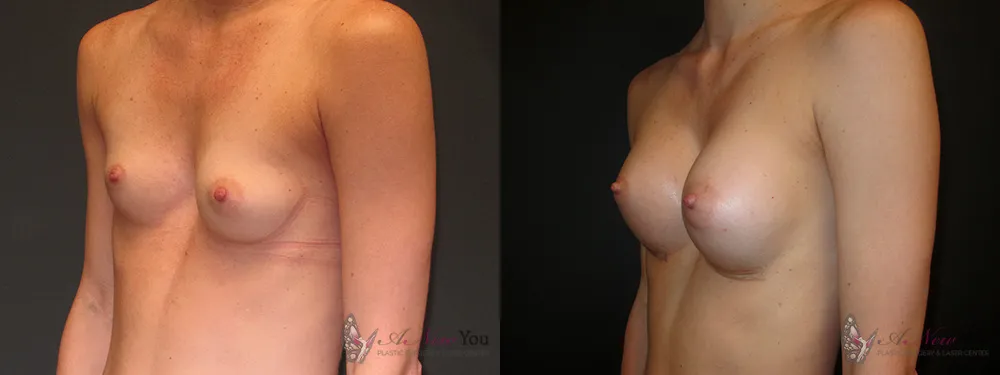 breast-augmentation-29a-ba1