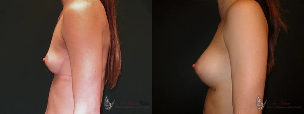 breast-augmentation-29a-ba2