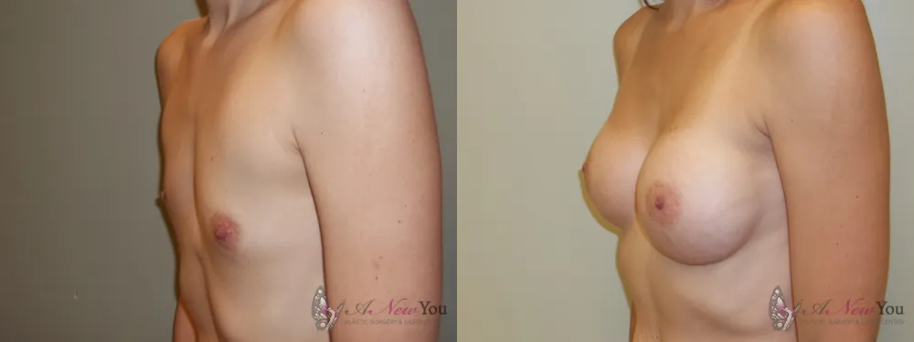 breast-augmentation-30a-ba1